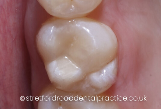 White Fillings Headington, Composite Fillings Oxford